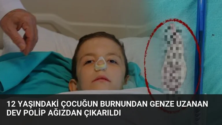12 Yaşındaki Çocuğun Burnundan Genze Uzanan Dev Polip Ağızdan Çıkarıldı