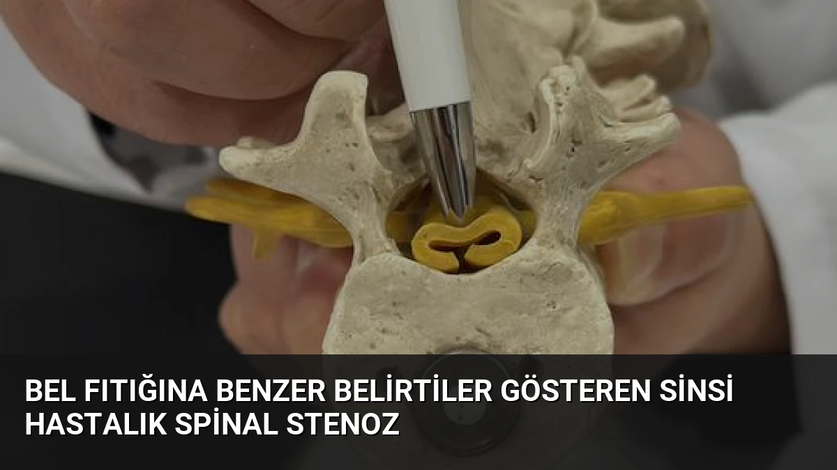 Bel Fıtığına Benzer Belirtiler Gösteren Sinsi Hastalık Spinal Stenoz