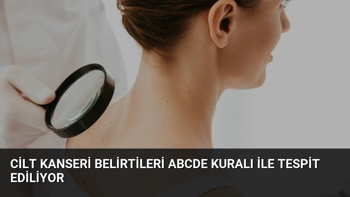Cilt Kanseri Belirtileri ABCDE Kuralı ile Tespit Ediliyor